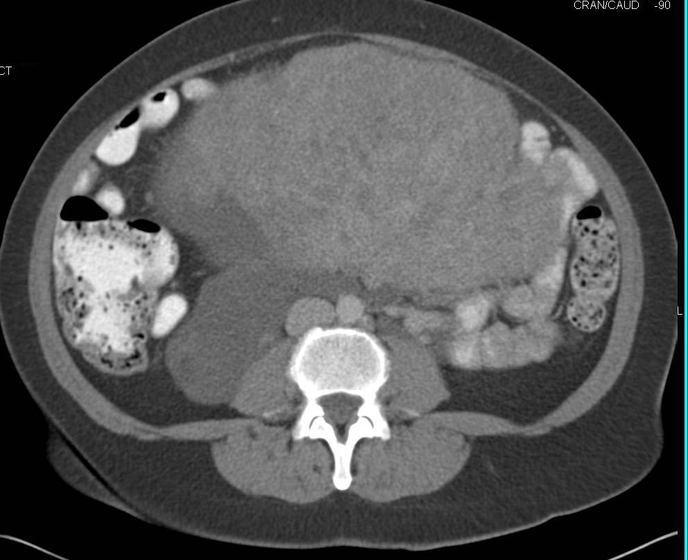 Uterine Fibroids - CTisus CT Scan