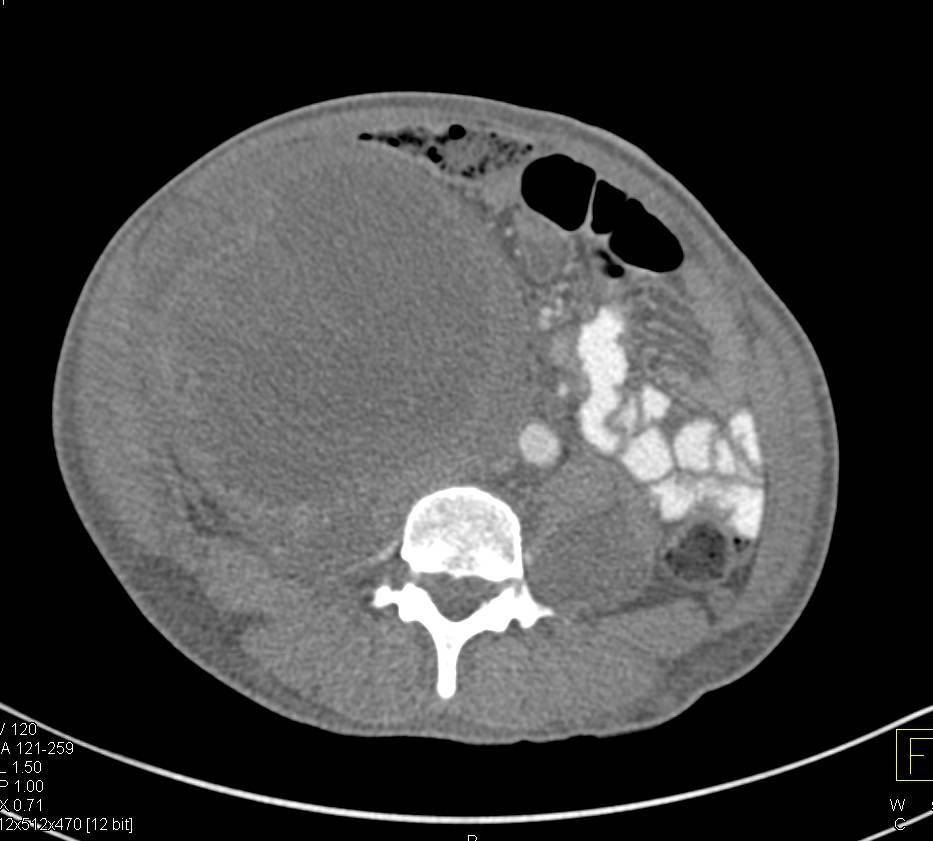 Ovarian Cancer with Right Lower Quadrant Tumor - CTisus CT Scan