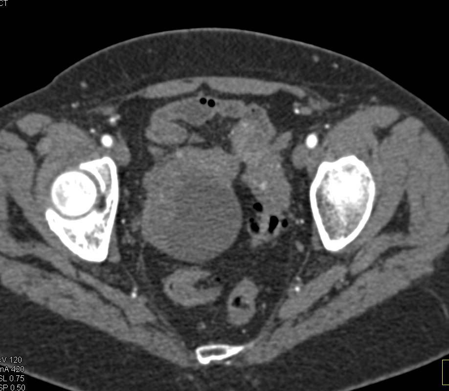 Unusual Case of Renal Cell Carcinoma Metastatic to the Ovary - CTisus CT Scan