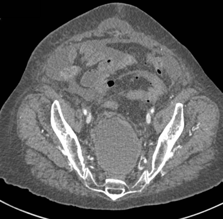 Large Pelvic Bleed - CTisus CT Scan