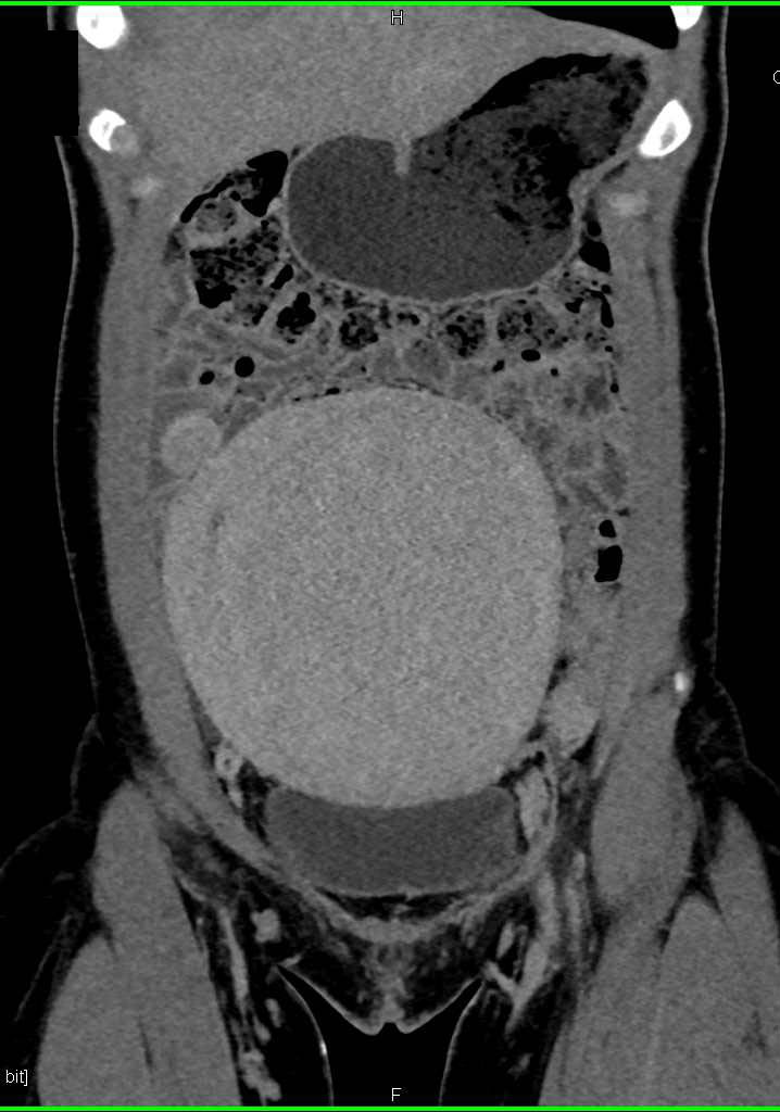 Vascular Uterine Fibroids - CTisus CT Scan