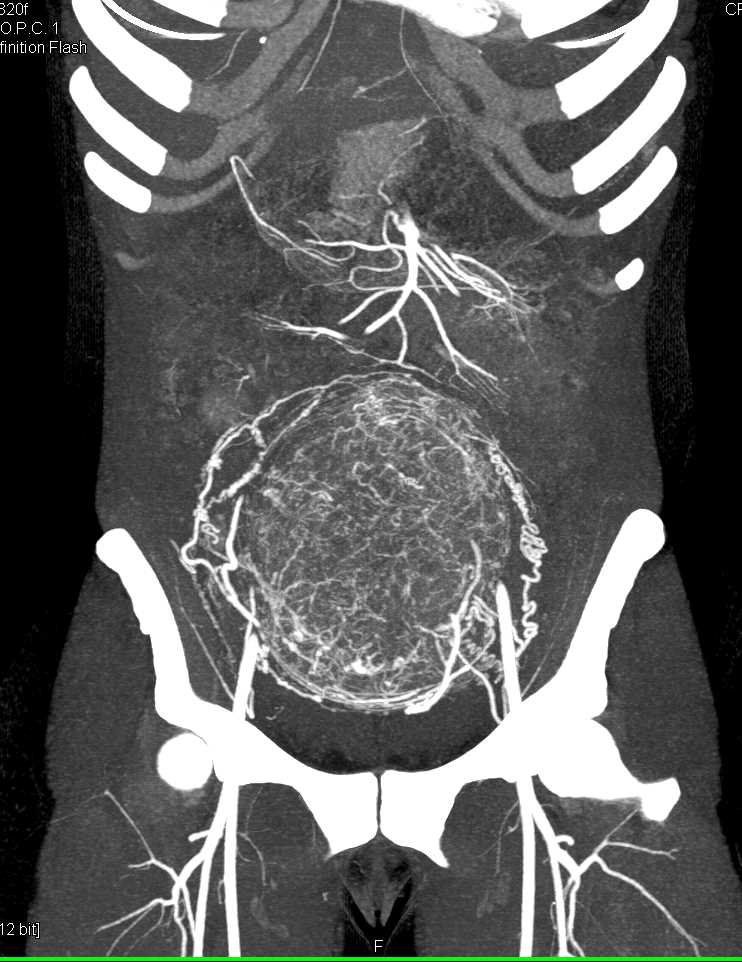 Vascular Uterine Tumor - CTisus CT Scan