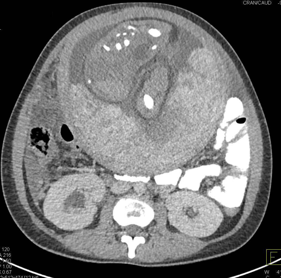 Appendicitis in a Pregnant Patient - CTisus CT Scan