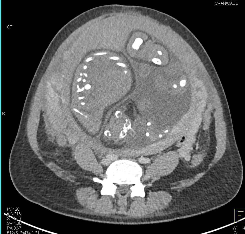 Acute Appendicitis in a Pregnant Patient - CTisus CT Scan