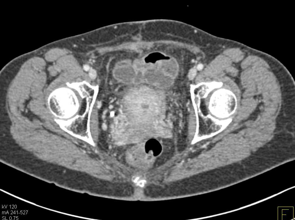 Cystic Ovarian Cancer - CTisus CT Scan