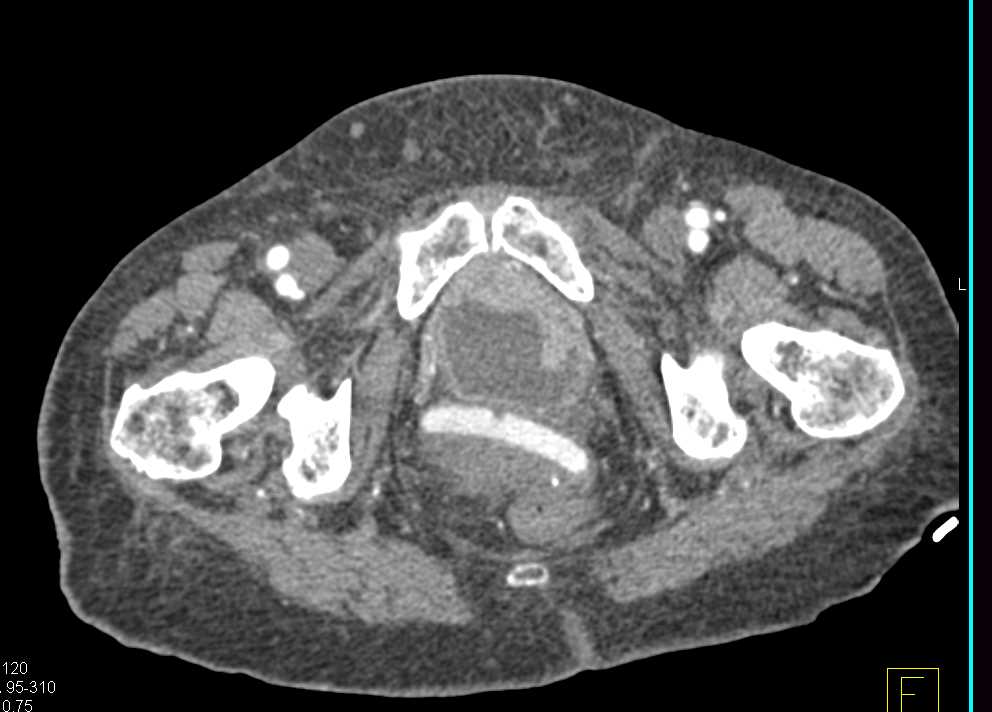 Ovarian Carcinomatosis with Displaced Pessary - CTisus CT Scan