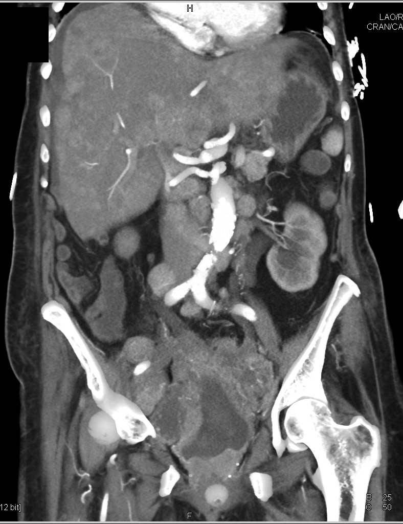 Ovarian Carcinomatosis with Displaced Pessary - CTisus CT Scan