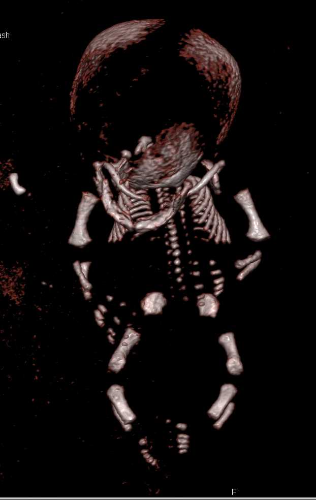 CT of Fetus with Skeletal Dysplasia - CTisus CT Scan