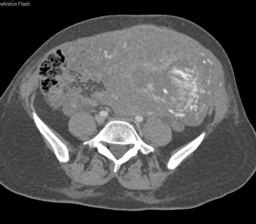 Gestational Trophoblastic Disease with Impressive Vascularity - CTisus CT Scan