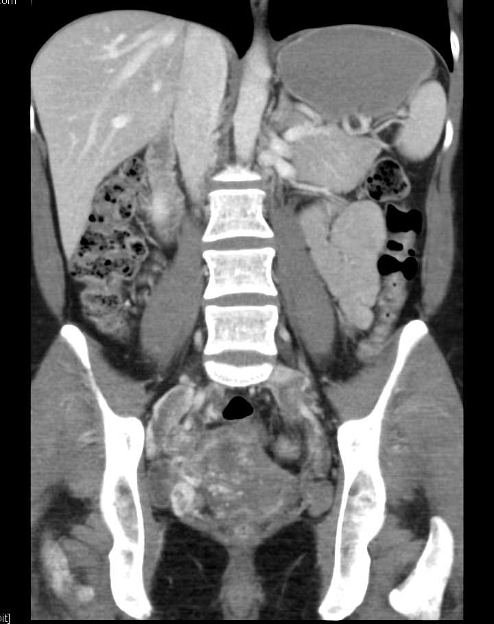 Intravenous leiomyomatosis with inferior vena cava  extension - CTisus CT Scan