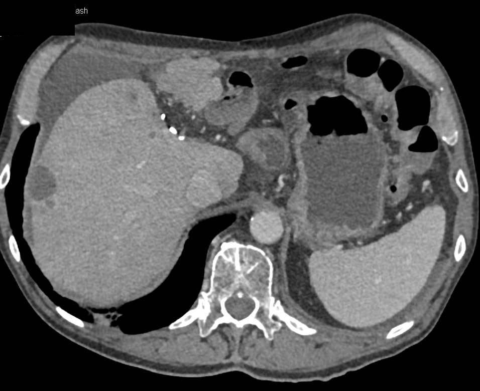 Ovarian Cancer with Ascites and Liver Implants - CTisus CT Scan