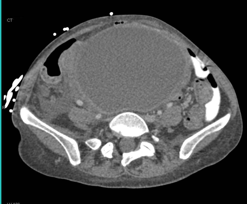 Ovarian Carcinoma - CTisus CT Scan