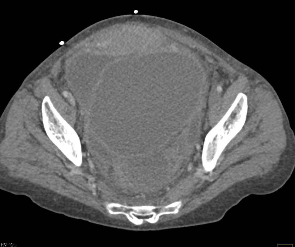 Ovarian Carcinoma - CTisus CT Scan