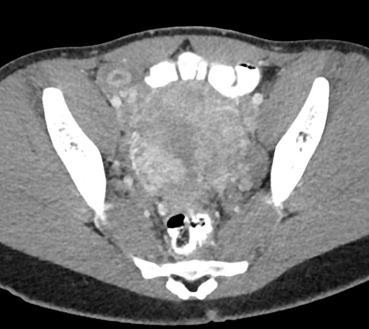 Unsuspected Intrauterine Pregnancy - OB/GYN Case Studies - CTisus CT ...