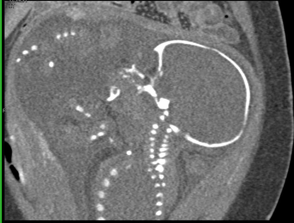 Fetus in Breech Position - CTisus CT Scan