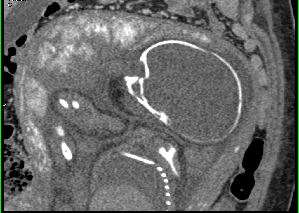 Fetus in Breech Position - CTisus CT Scan