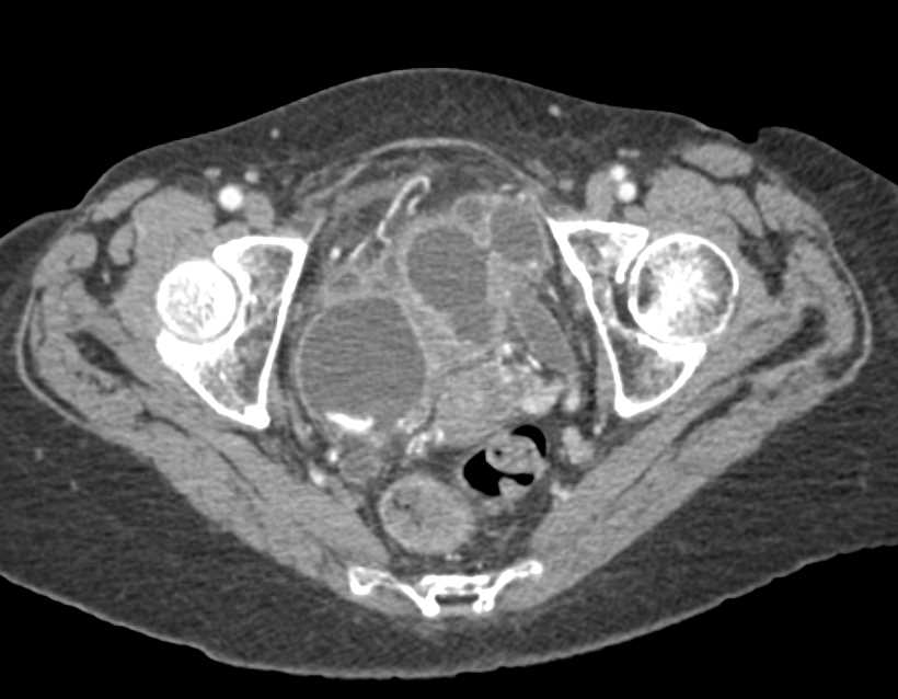 Tubo-Ovarian Abscesses - CTisus CT Scan