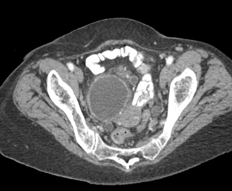 Tubo-Ovarian Abscesses - OB/GYN Case Studies - CTisus CT Scanning