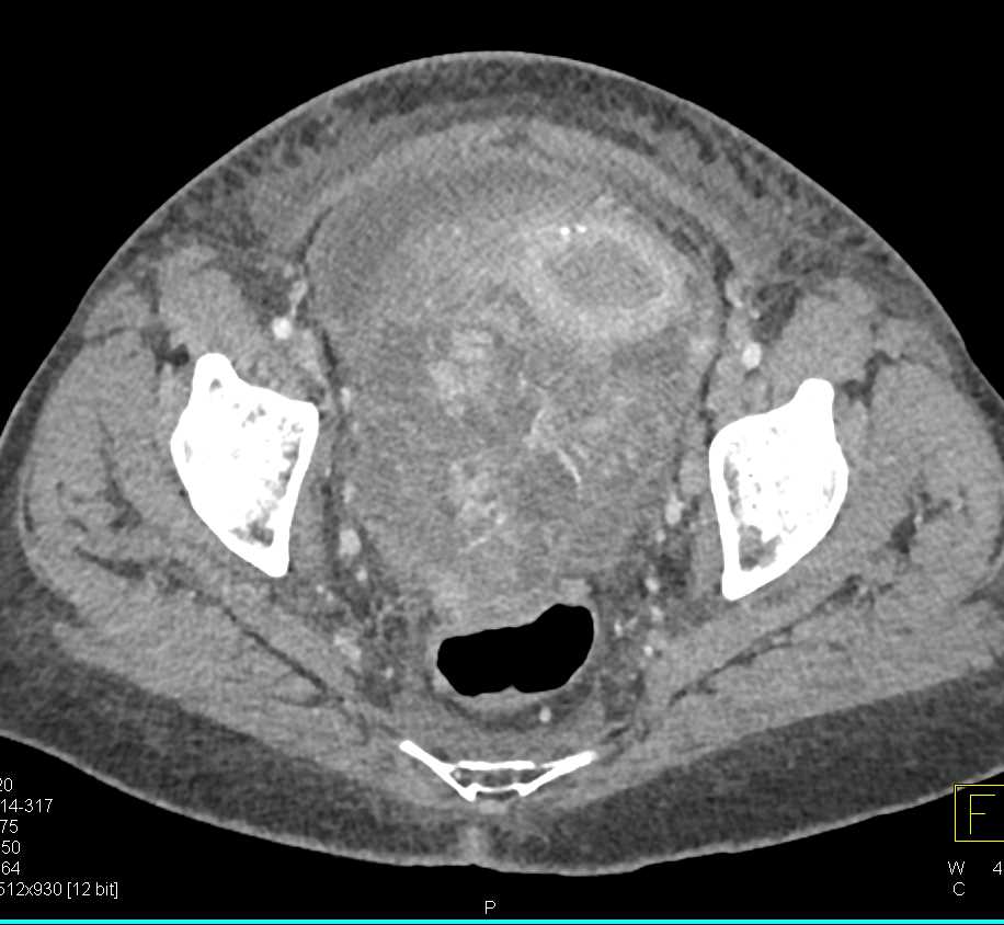 Ovarian Carcinoma with Ascites - CTisus CT Scan