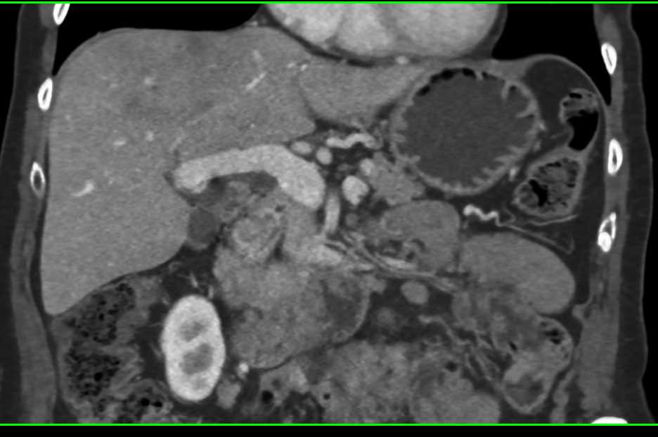 Ovarian Carcinomatosis - CTisus CT Scan