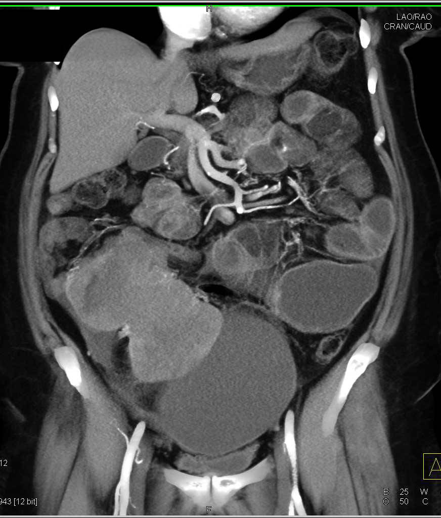 Ovarian Cystadenocarcinoma - CTisus CT Scan