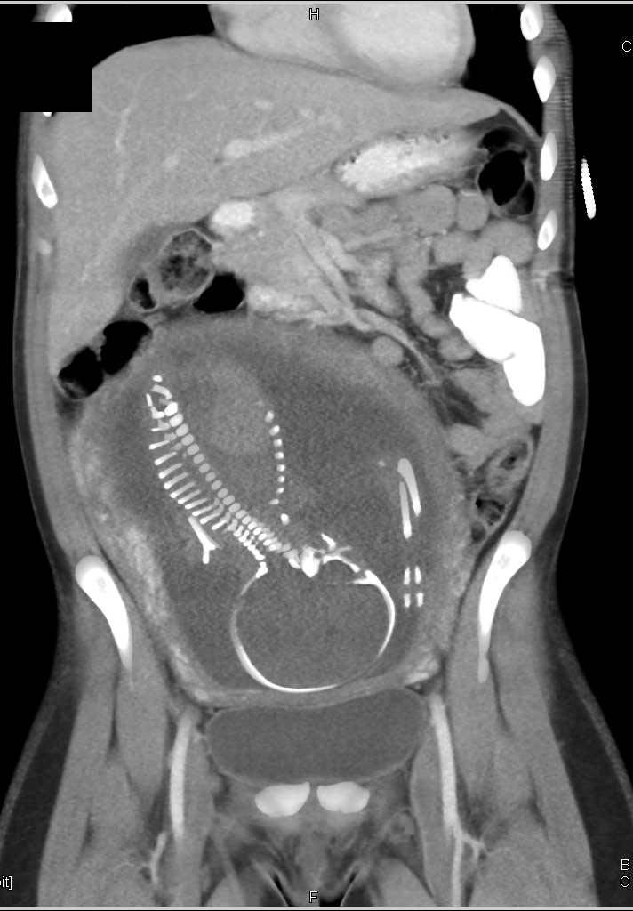 CT of Fetus in a Trauma patient - CTisus CT Scan