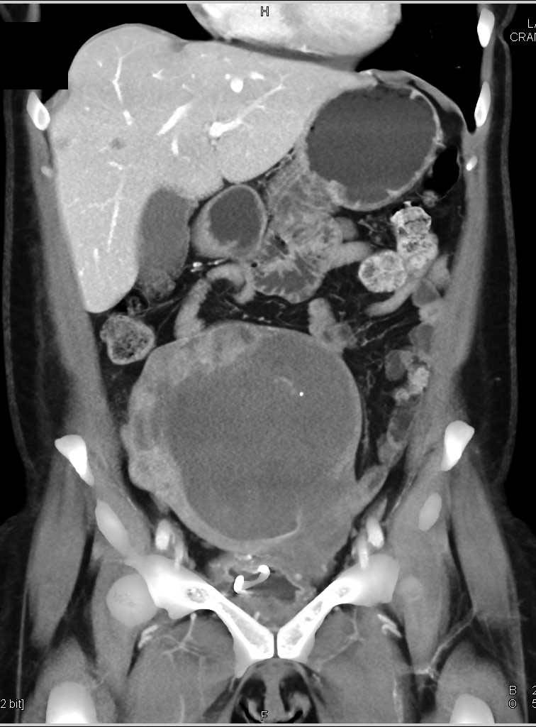 Ovarian Cystadenocarcinoma - CTisus CT Scan