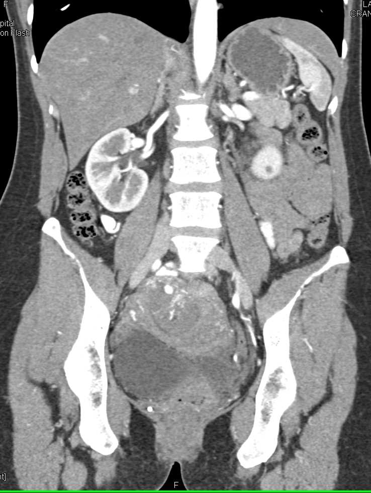 Intrauterine Pregnancy That Was Unexpected - CTisus CT Scan