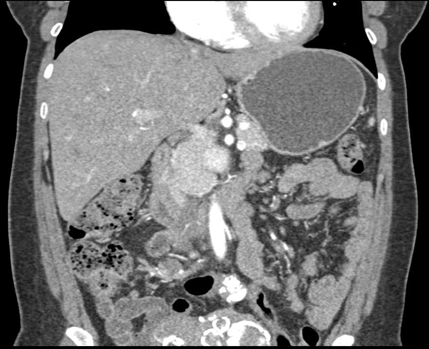 Calcified Uterine Fibroids - CTisus CT Scan