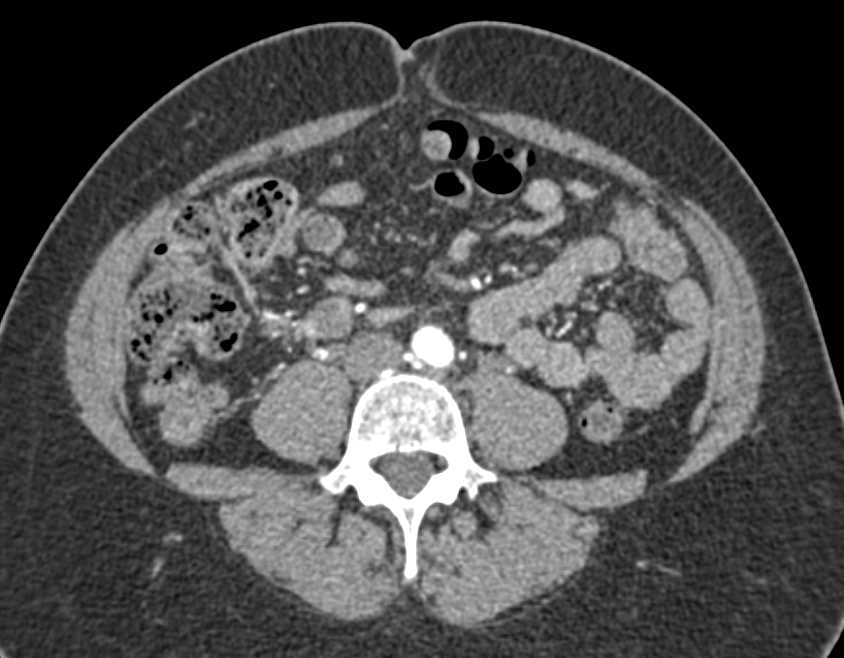 Calcified Uterine Fibroids and Incidental GIST Tumor in Small Bowel - CTisus CT Scan