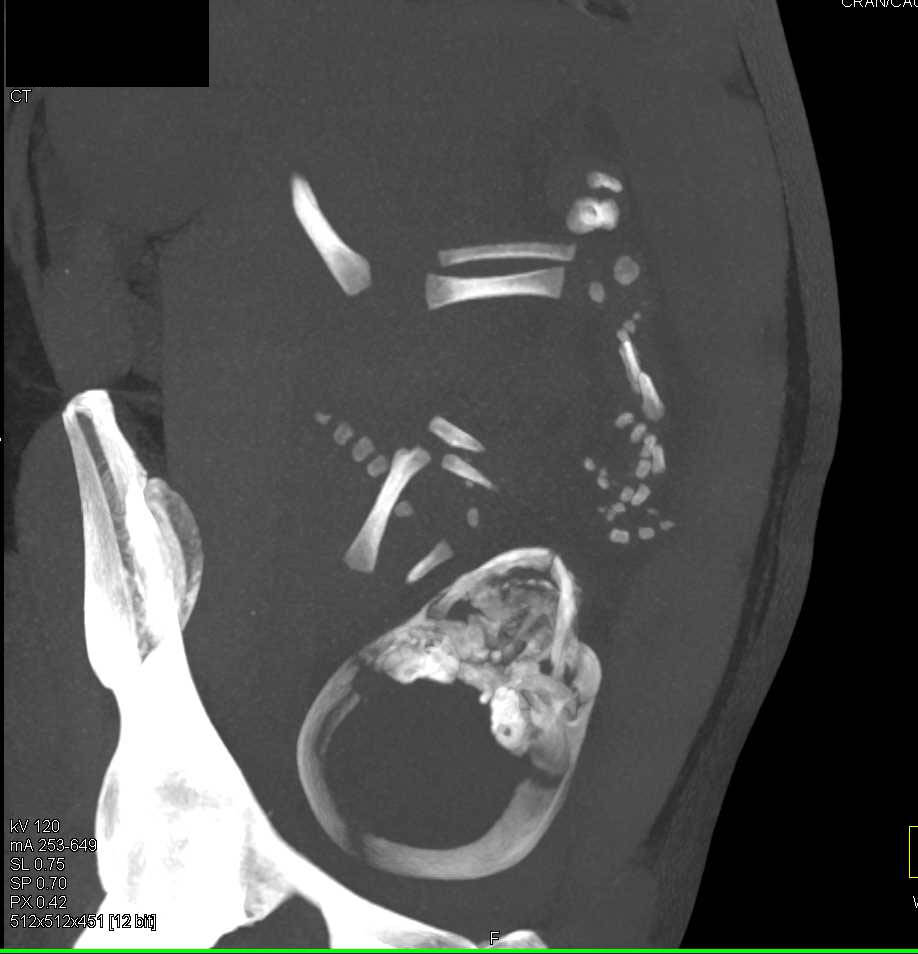 Intrauterine Pregnancy - OB/GYN Case Studies - CTisus CT Scanning