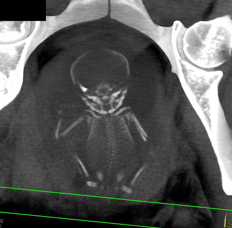 Intrauterine Pregnancy Evaluated for Cranial Suture Fusion - CTisus CT Scan