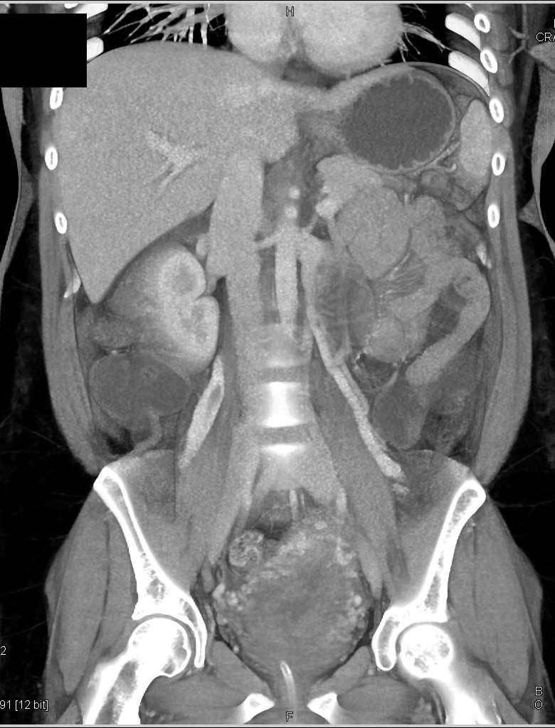 Post Partum Uterus - OB/GYN Case Studies - CTisus CT Scanning