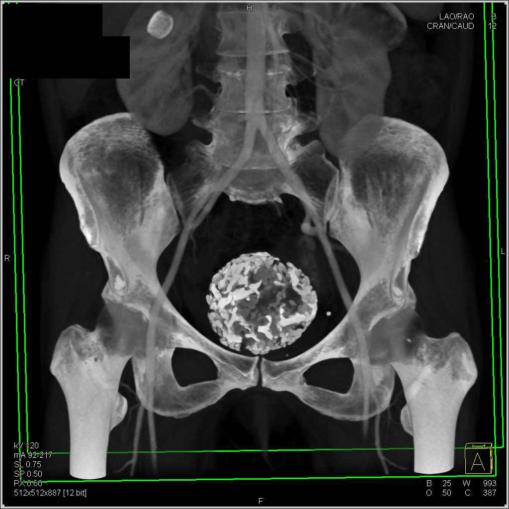 Calcified Uterine Fibroids - OB/GYN Case Studies - CTisus CT Scanning