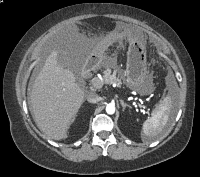 Ovarian Cancer with Carcinomatosis - CTisus CT Scan
