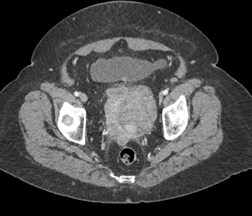 Ovarian Cancer Ct Scan With Contrast