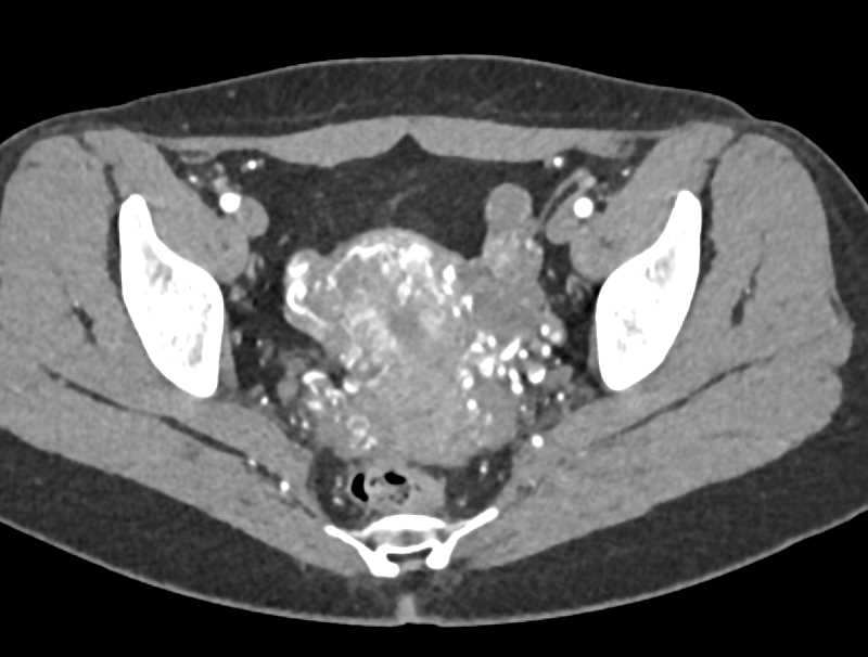 Pelvic Congestion Syndrome with Huge Pelvic Varices and Collaterals - CTisus CT Scan