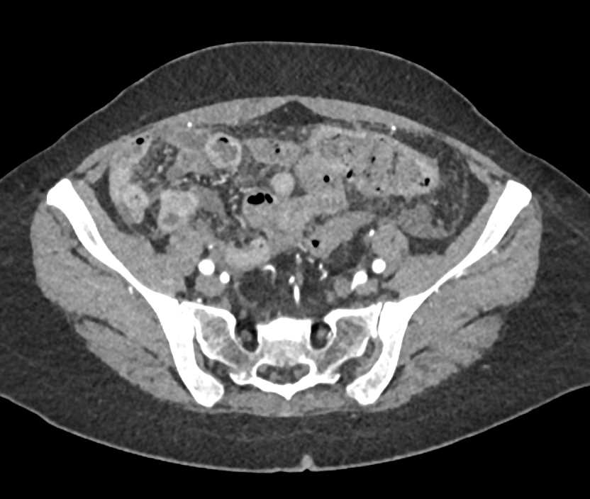 Ovarian Cancer and Carcinomatosis - CTisus CT Scan