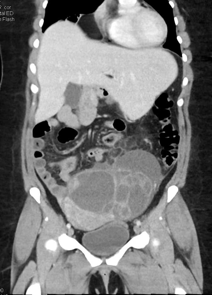 Ovarian Carcinoma - CTisus CT Scan