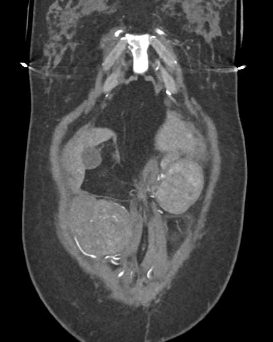 Amazing Case of Endometriosis Involving the Abdominal Wall and Abdomen - CTisus CT Scan