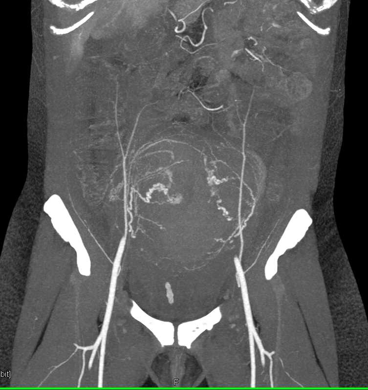 Postpartum Bleed s/p C-section - CTisus CT Scan