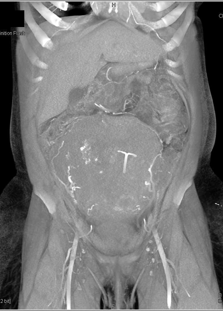 IUD in the Wall of a Postpartum Uterus - CTisus CT Scan