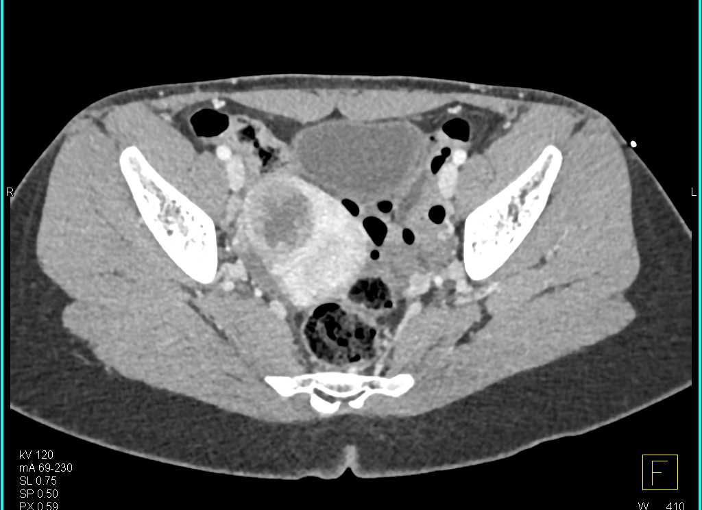 Uterine Fibroids - OB/GYN Case Studies - CTisus CT Scanning