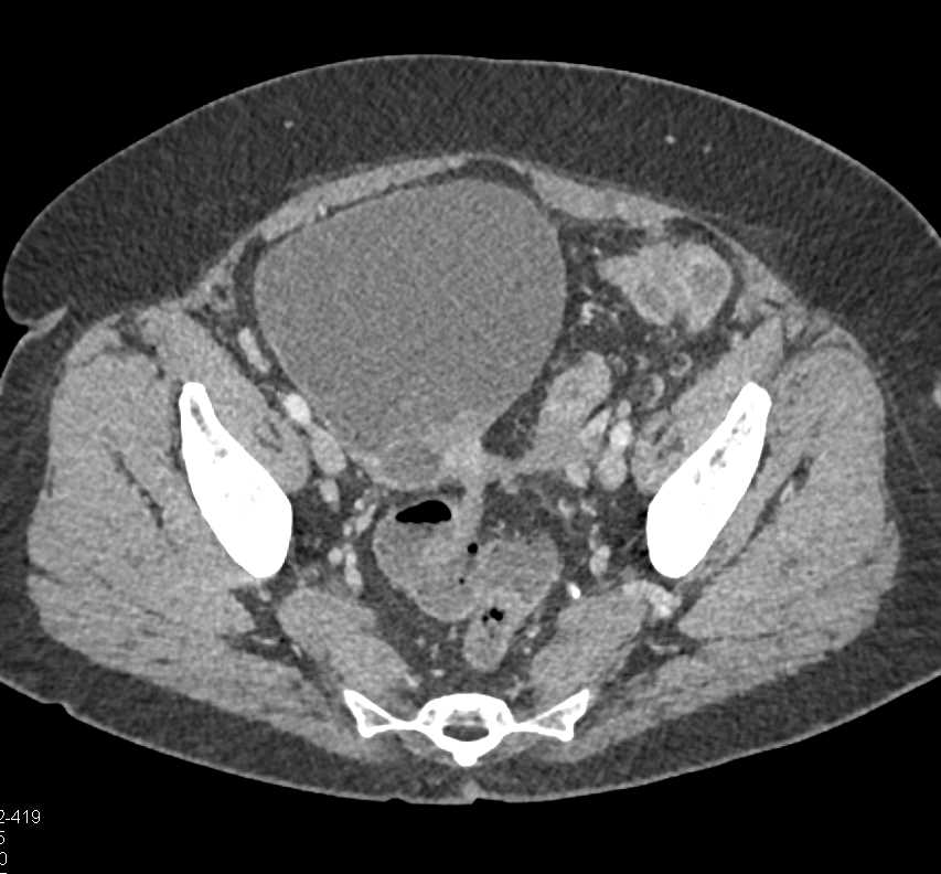 Ovarian Carcinoma - CTisus CT Scan