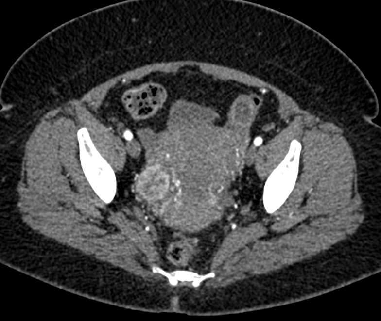 Uterine Fibroids - CTisus CT Scan