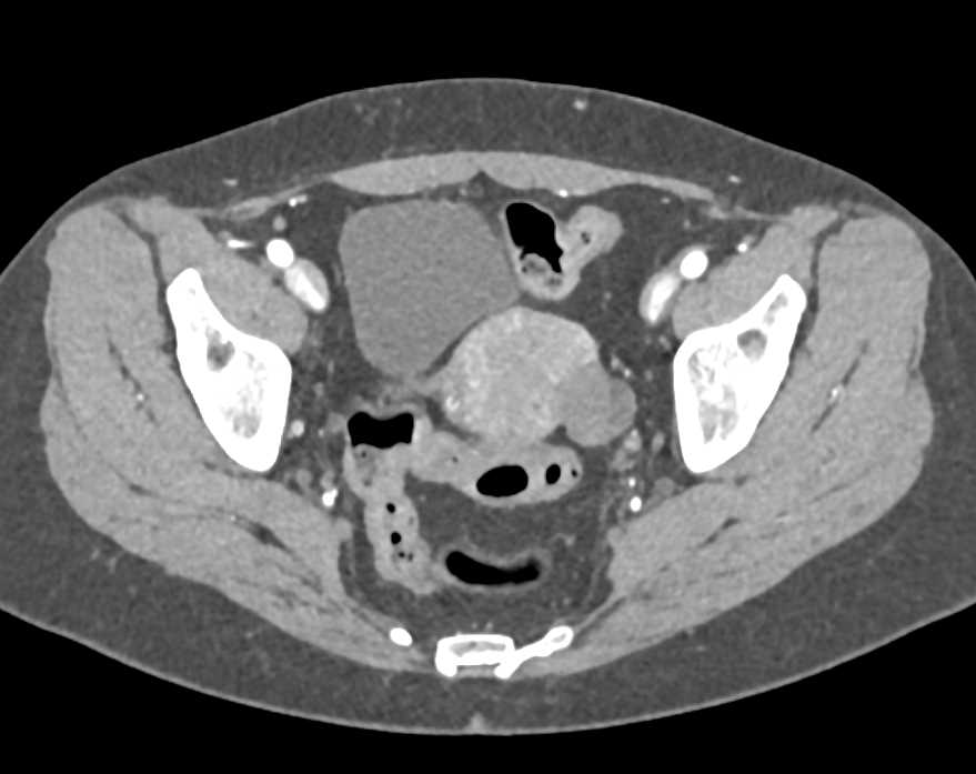 Hemorrhagic Cyst Left Ovary - CTisus CT Scan