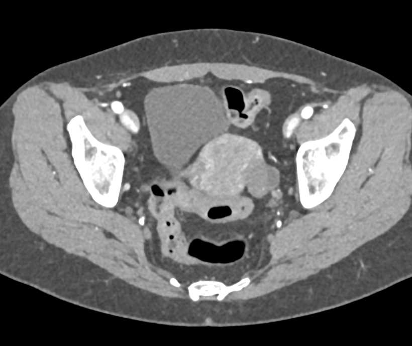 Hemorrhagic Cyst Left Ovary - CTisus CT Scan