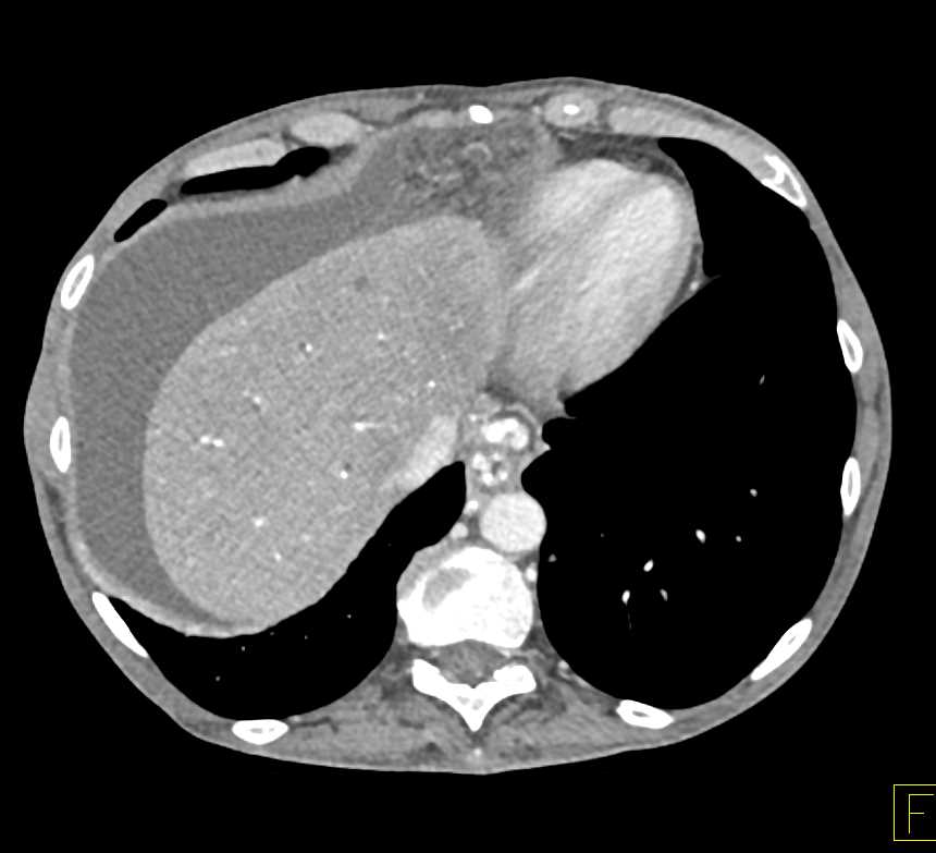 Ovarian Cystadenocarcinoma - CTisus CT Scan