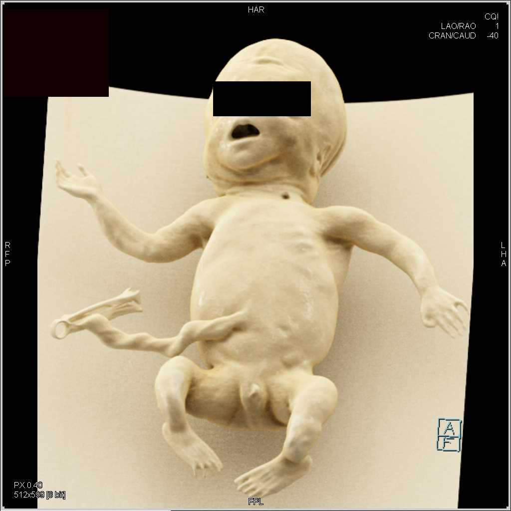 Fetus CT - CTisus CT Scan