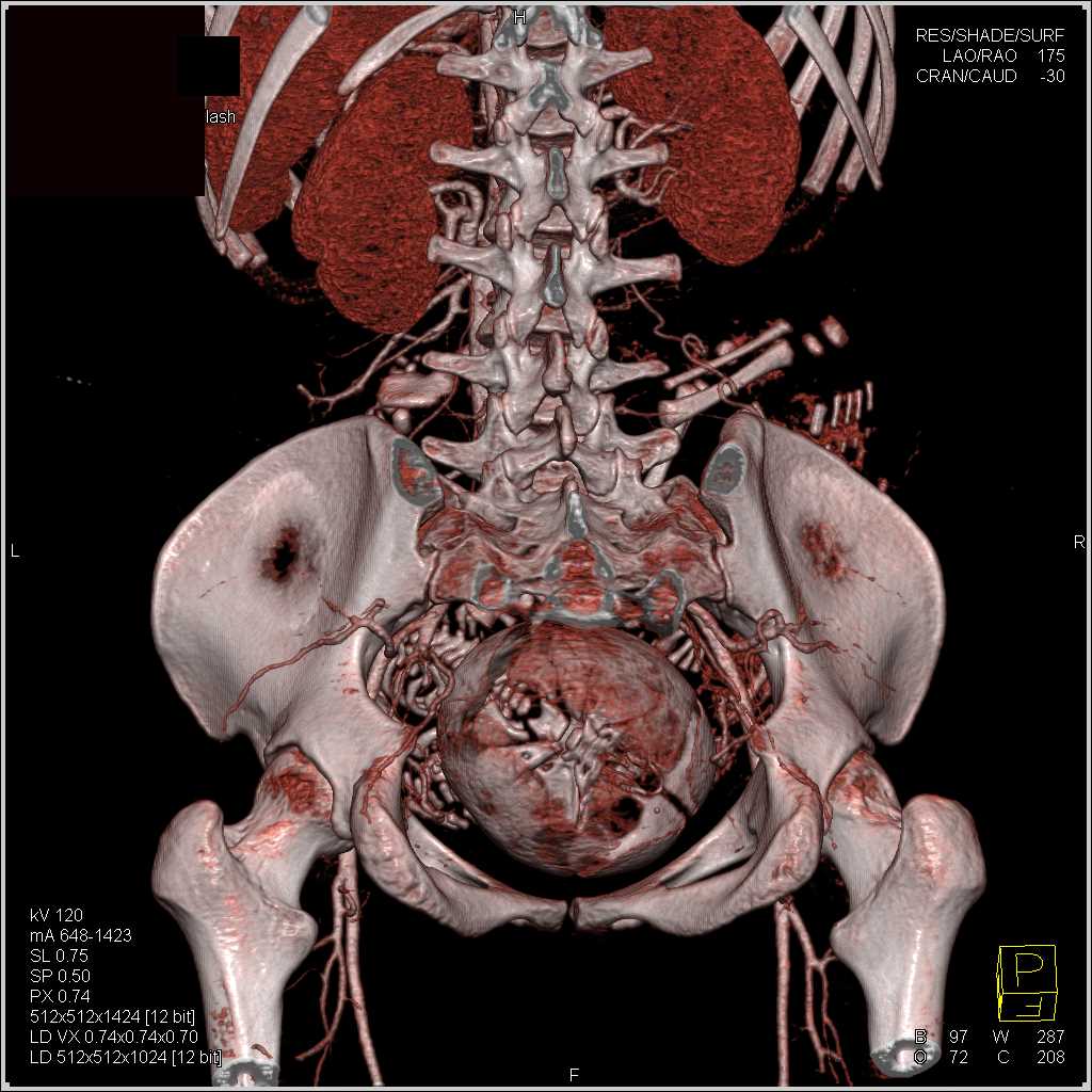 Perfusion Changes in the Fetus in a Patient Post Trauma - CTisus CT Scan